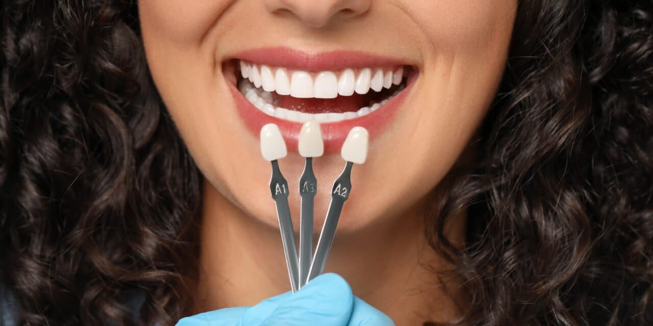 How Long Do Veneers Last? A Complete Guide 2024