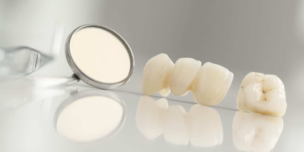 Single Tooth Bridge: Transform Your Smile Without Implants