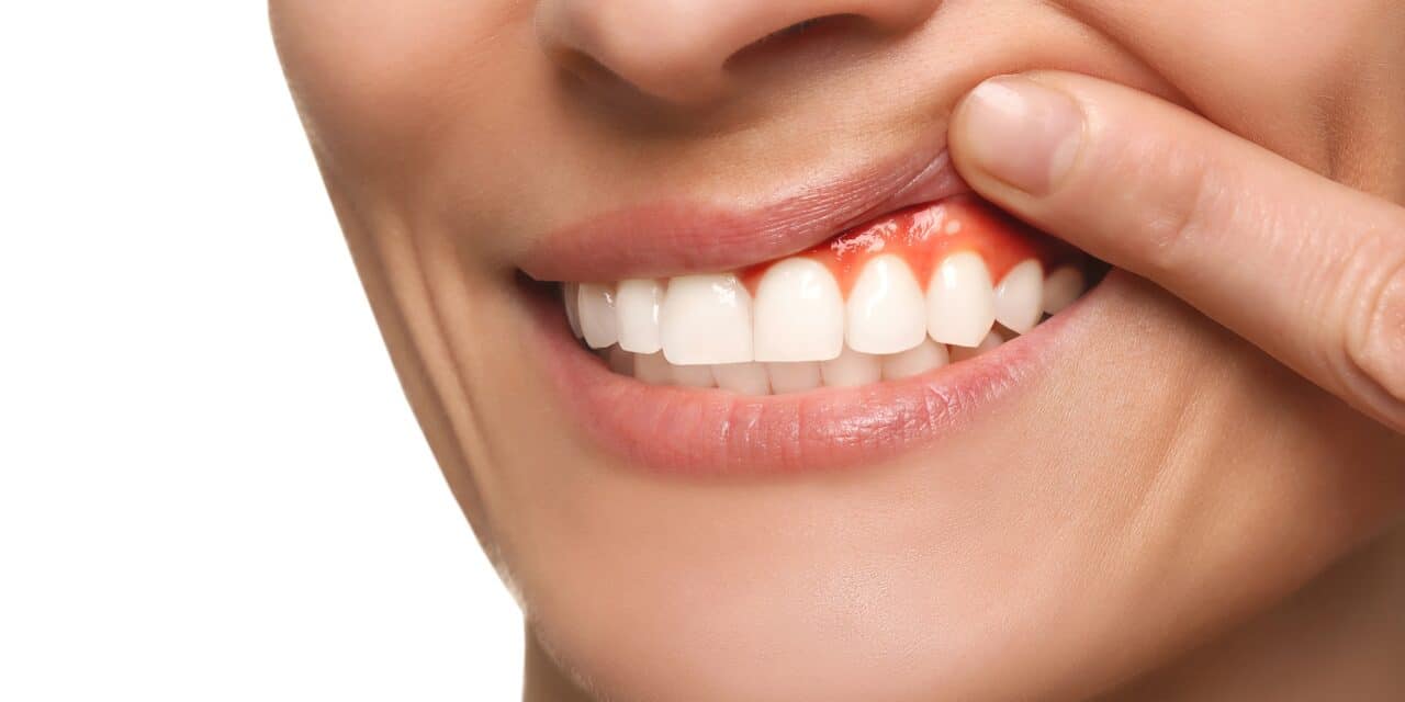Inflamed Gums After Flossing? 7 Dentist-Backed Solutions