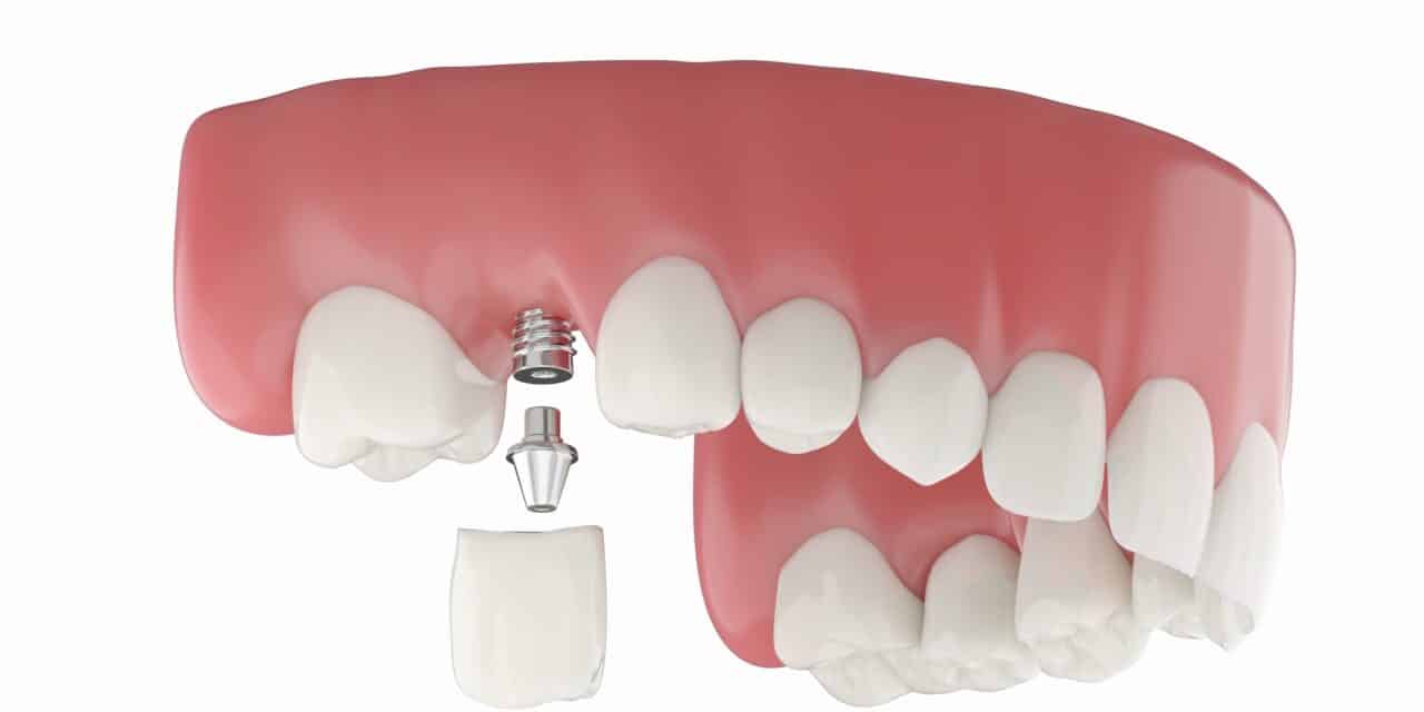 Dental Implant for Molars: Your Ultimate Recovery & Success Blueprint