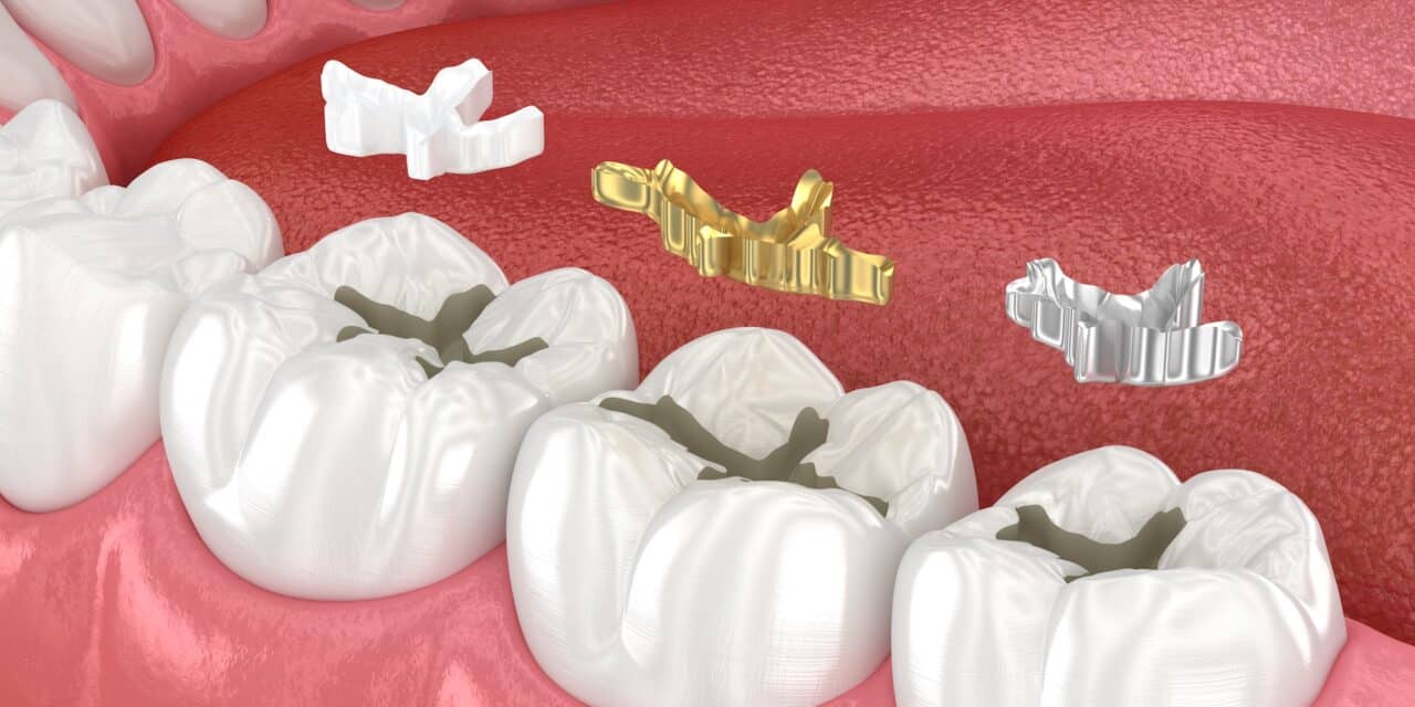 Can Cavity Fillings Fall Out? 7 Warning Signs & Emergency Steps