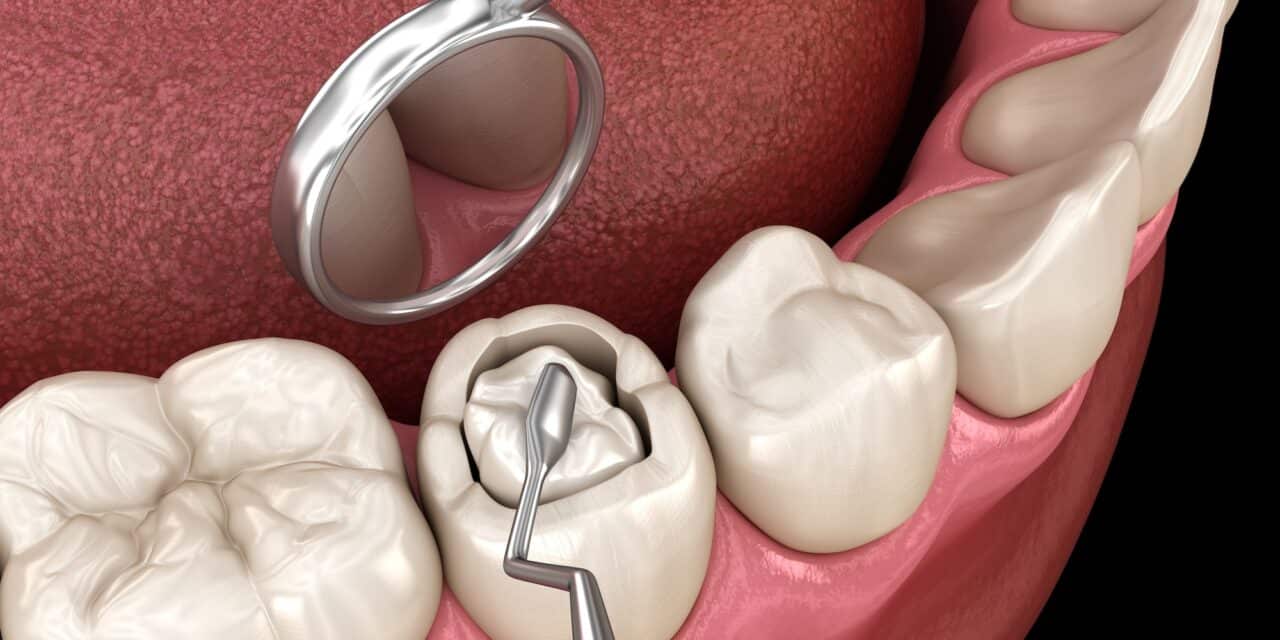 Root Filling vs Extraction: Save or Remove Your Tooth?